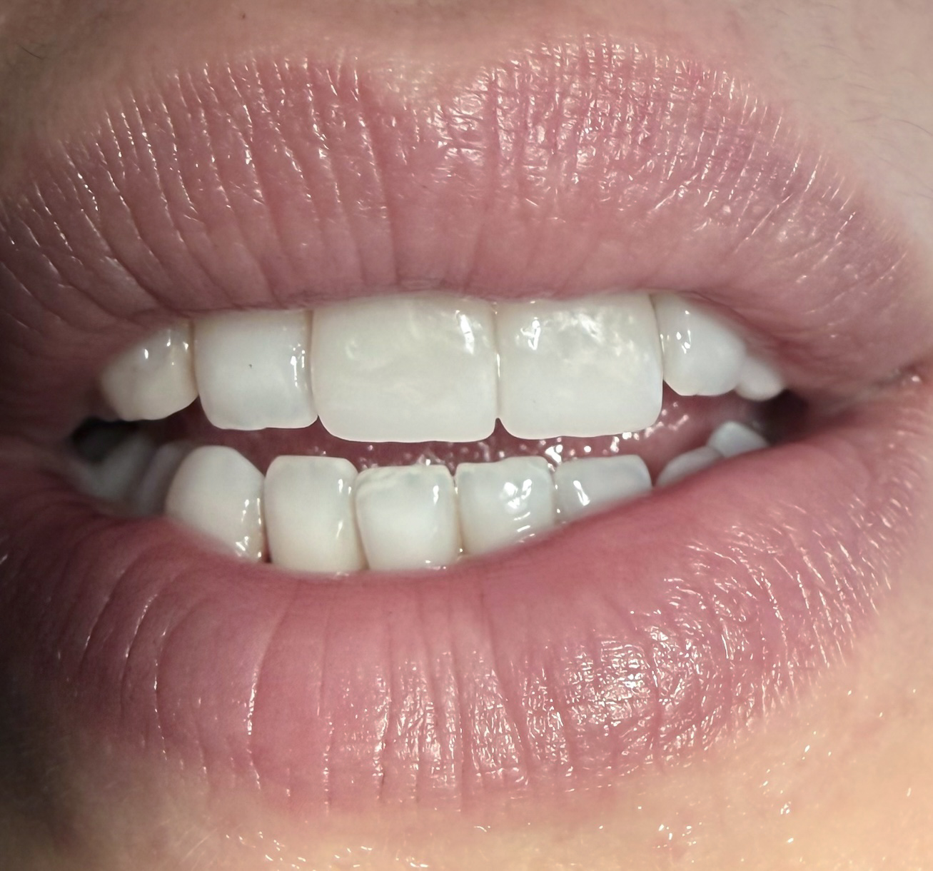 Porcelain veneers result after treatment